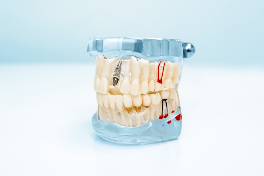 Why Dental Implants Are The Best Option To Restore Missing Teeth?